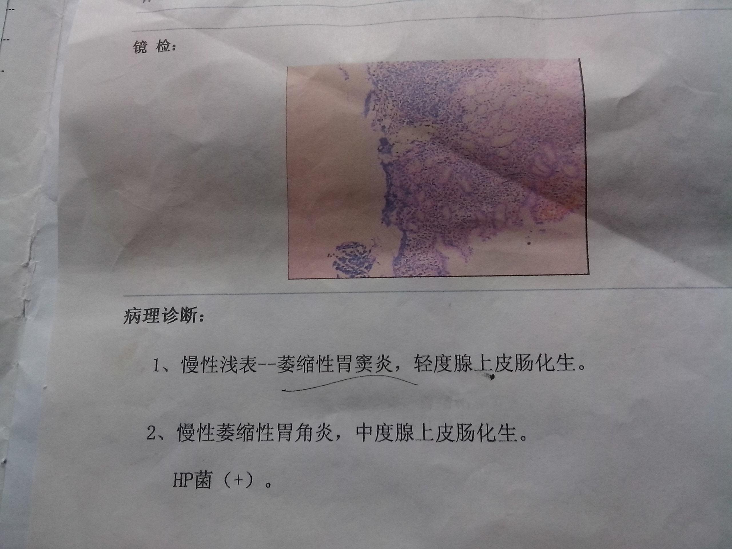 生命的奇迹，一位女孩与胃萎缩的抗争—从90多斤到35斤的重生之旅
