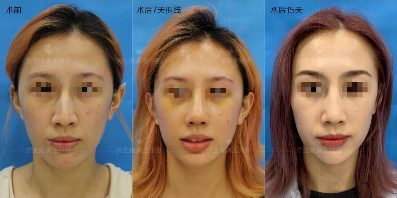 宋轶发声，以自然之美，回应整容争议的温柔力量
