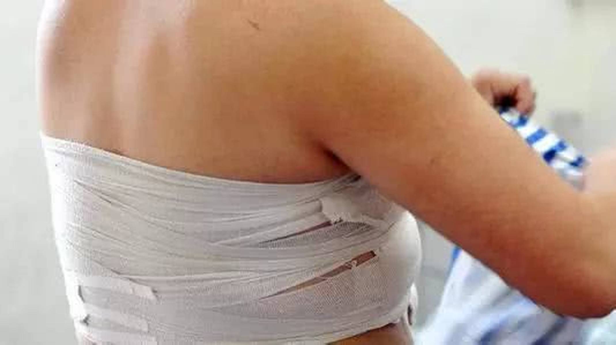 14岁少女惊觉鸡蛋大乳房肿块，早发现早治疗的警示