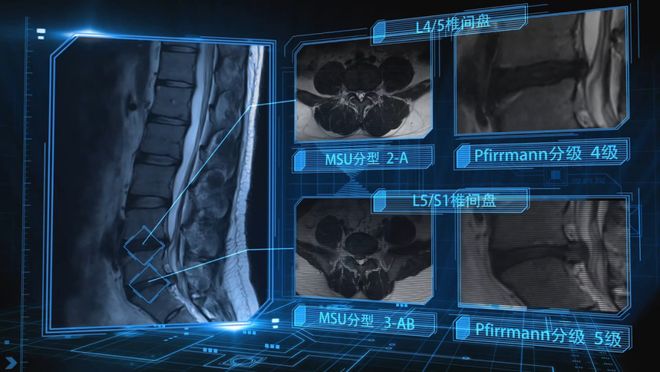 全球首款骨胶水在浙江研发成功，开启骨科治疗新纪元
