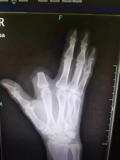 惊险一幕，男子被蛇咬伤，骑车紧急就医半路毒发摔倒