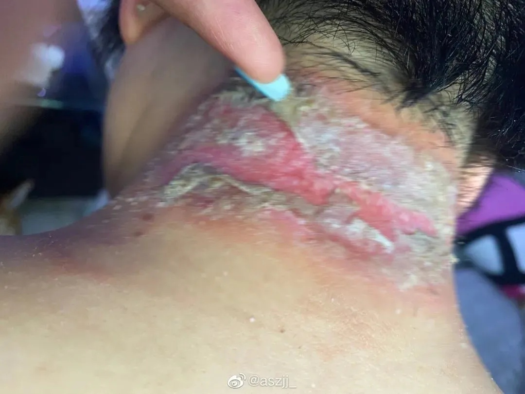 洱海畔的网红之殇，歪脖子树疑遭人为砍断的背后