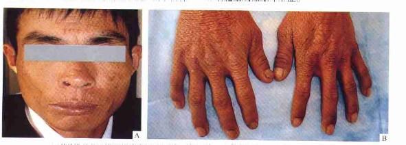 男孩自查文献确诊罕见卟啉病，勇气与智慧的奇迹