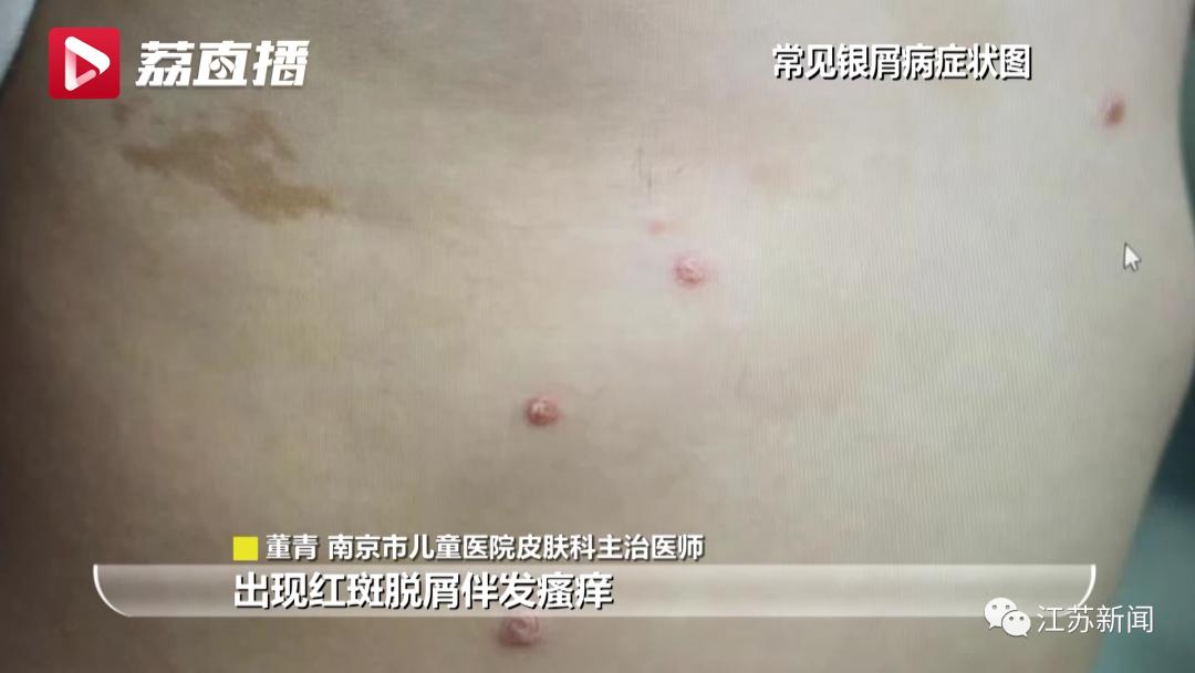 民间偏方灼伤女童事件,家长误判与科学教育的双重反思 民间偏方灼伤女童事件,家长误判与科学教育的双重反思