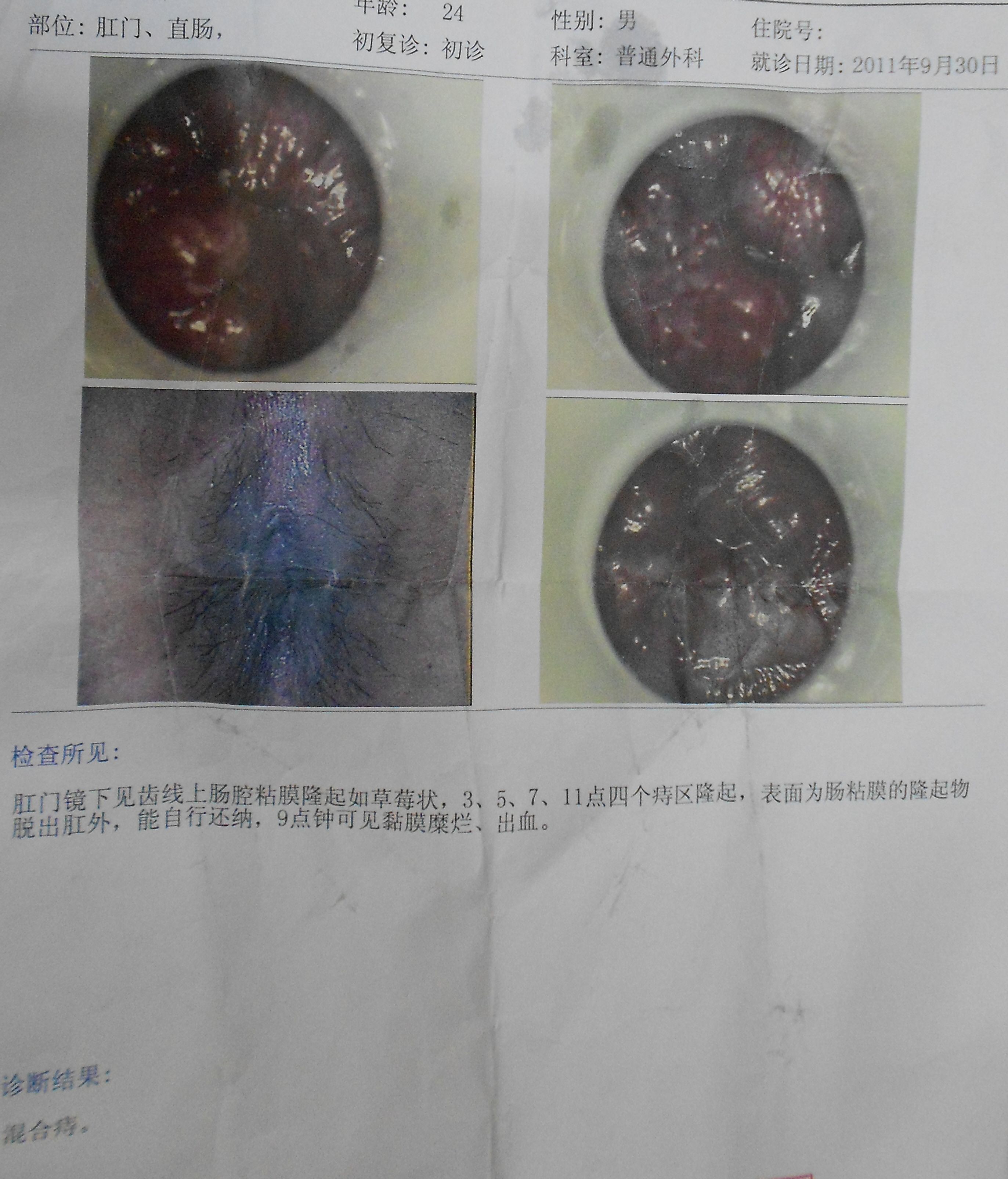 血色术后痛，华裔女子痔疮手术竟成生死劫